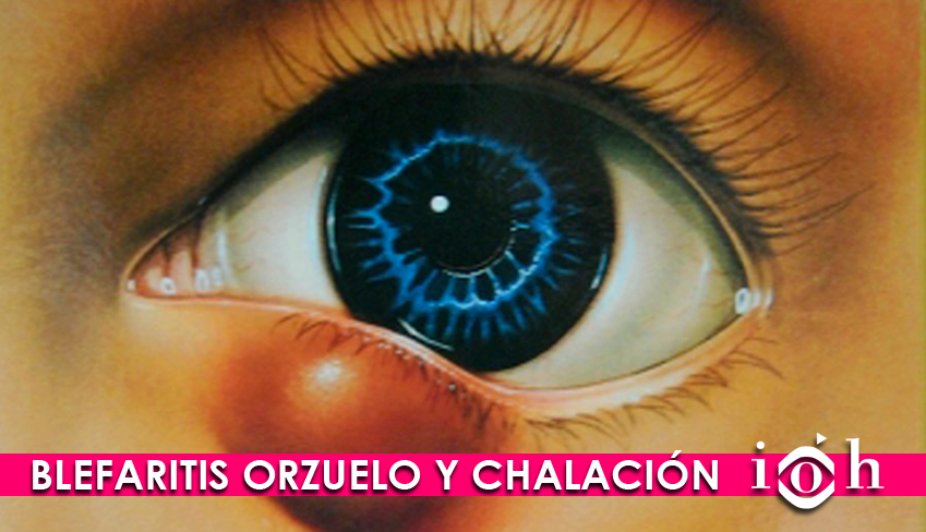 Cuales son los sintomas de un orzuelo en el ojo