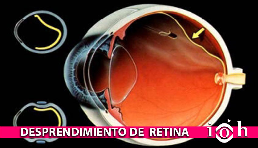 sintomas de adelgazamiento de retina sintomas de adelgazamiento de retina